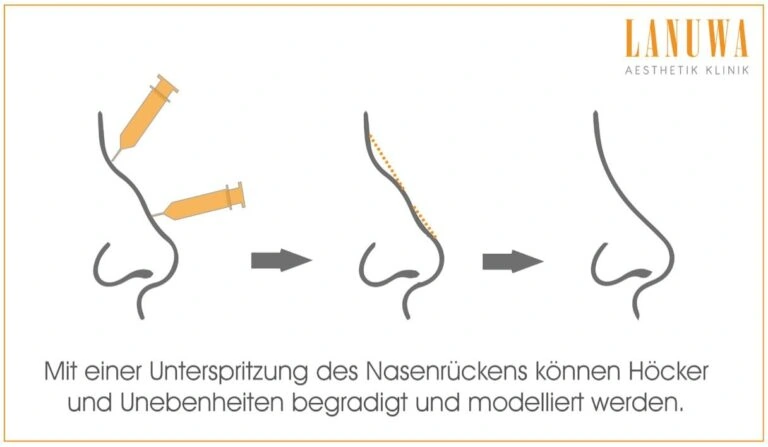 Nasenkorrektur ohne OP: Höcker und Unebenheiten mit Filler begradigen
