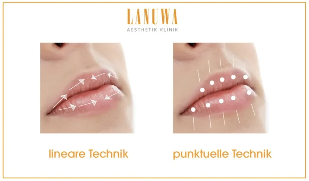 Techniken der Lippenunterspritzung: lineare Technik und punktuelle Technik