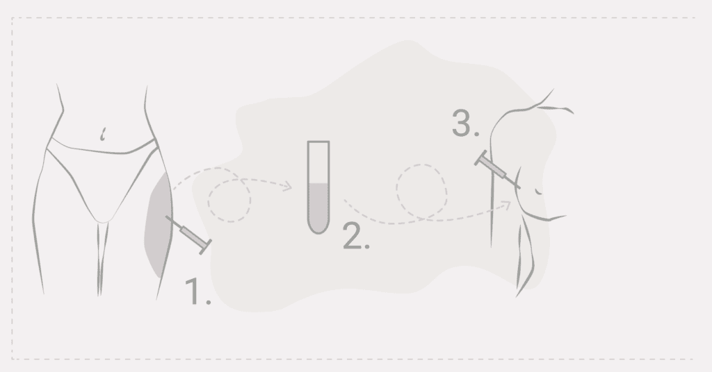Ablauf der Brustvergrößerung mit Eigenfett in drei Schritten: Fettentnahme, Aufbereitung und Injektion