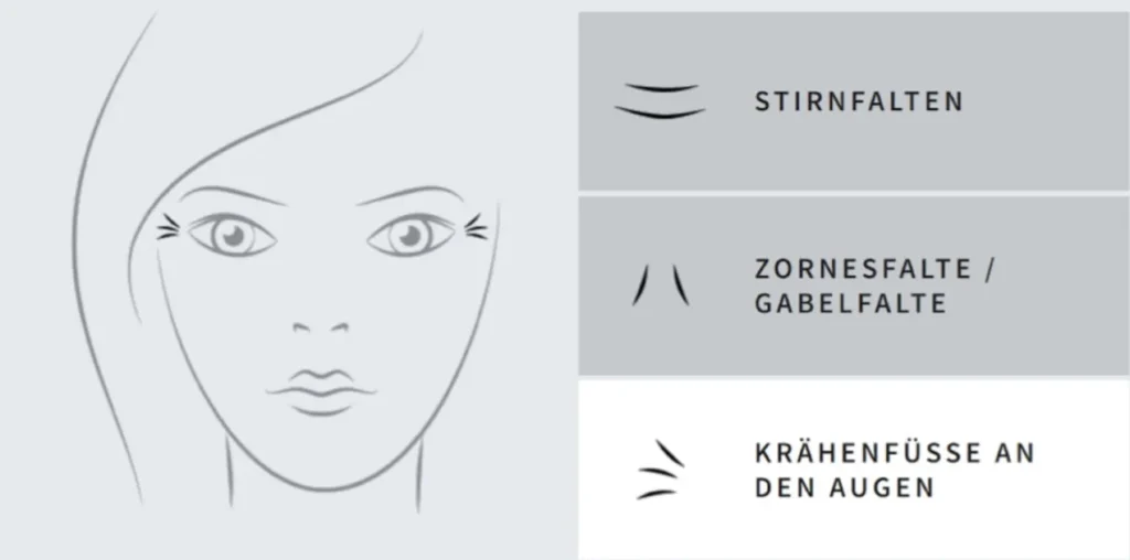 Botox Behandlungszonen: Stirnfalten, Zornesfalte und Krähenfüße