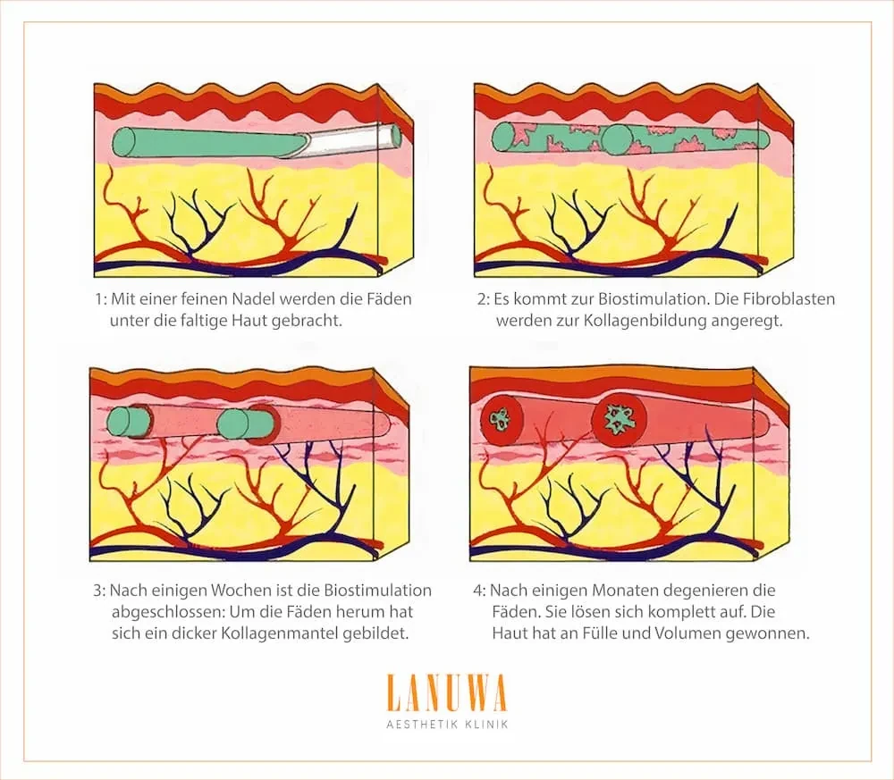 Fadenlifting Biostimulation - 4 Schritte der Kollagenbildung