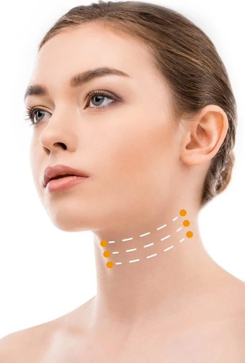 Fadenlifting Schema Hals - Gerade Schemata mit 16 Kegeln