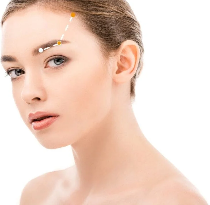 Fadenlifting Schema Stirn - Stumpfwinkliges Schema mit 8 Kegeln