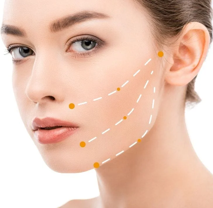 Fadenlifting Schema Wangen - Kombinierte Schemata