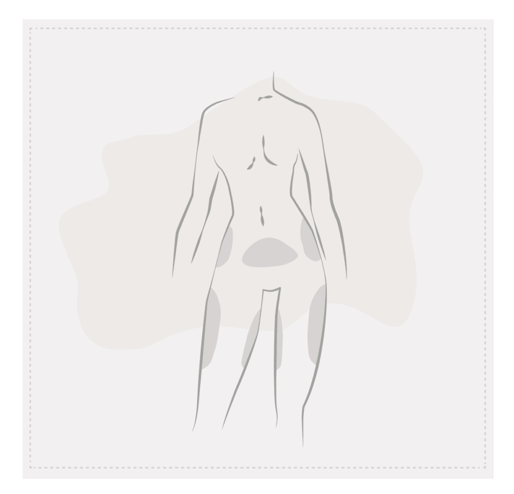 Geeignete Körperregionen zur Fettabsaugung: Bauch, Hüften, Oberschenkel und Rücken