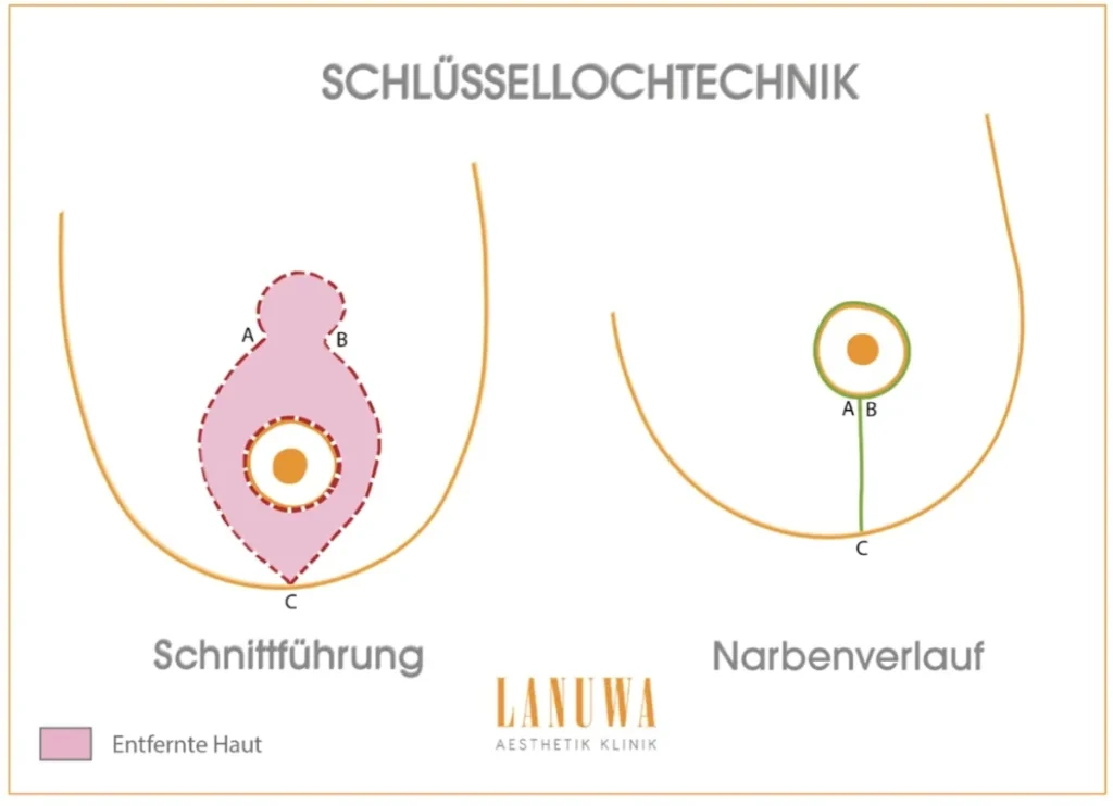 I-Schnitt Technik bei der Brustverkleinerung - Lejour-Methode