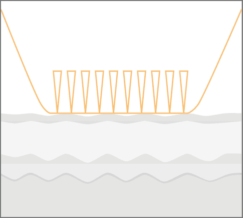 Schritt 1: Gerät wird mit eingezogenen Nadeln auf die Haut aufgesetzt