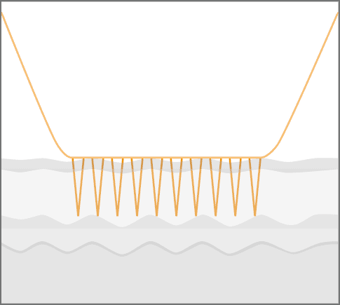 Schritt 2: Nadeln dringen sanft mit unterschiedlicher Tiefe ein