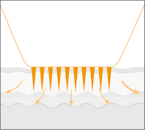 Schritt 3: Radiofrequenzenergie wird über die Nadelspitze abgegeben
