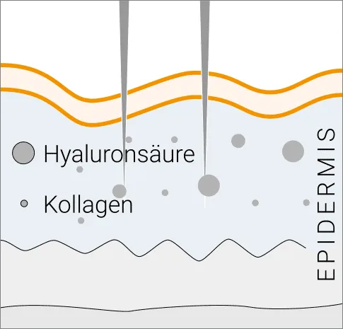 Während der Microneedling-Behandlung - Nadeln reizen Rezeptoren in der Epidermis