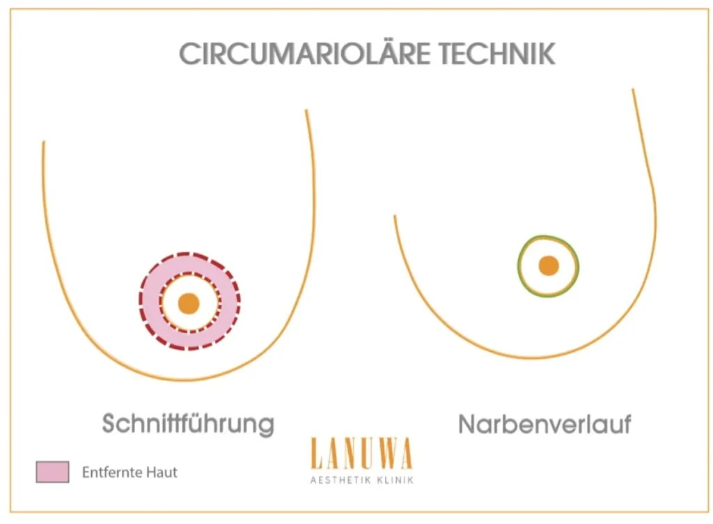 O-Schnitt Technik bei der Brustverkleinerung - kreisförmiger Schnitt um den Warzenhof