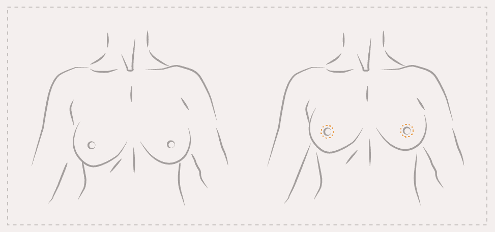 O-Schnitt Technik bei der Bruststraffung - Schnitt um den Warzenhof