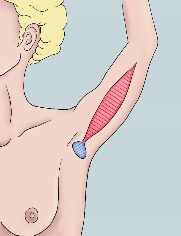 Oberarmstraffung Schnittführung - Illustration der OP-Technik