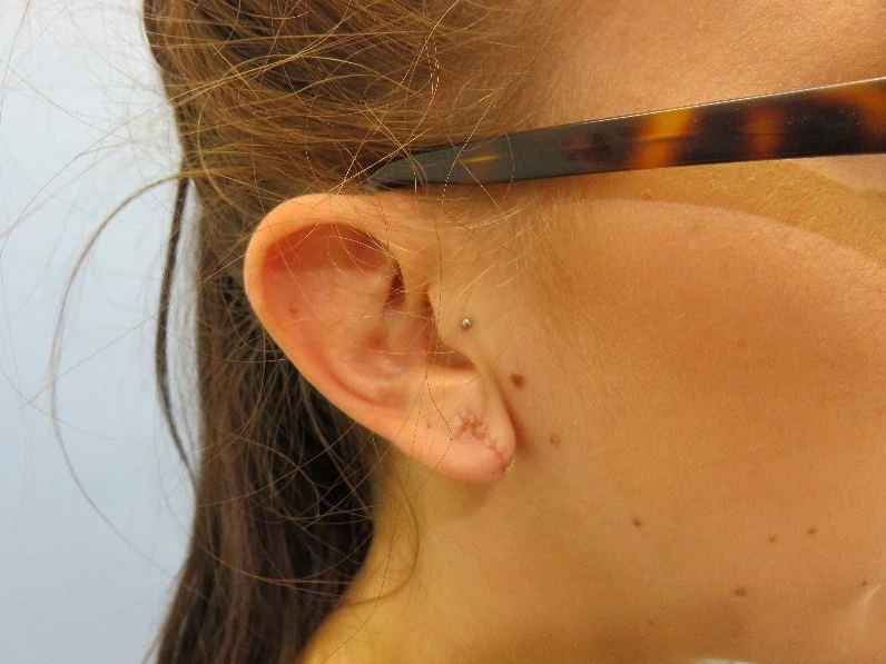 Frische OP-Narbe nach Tunnel-Rekonstruktion