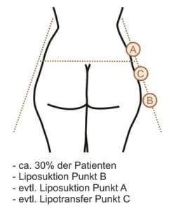 A-förmige Po-Form mit Behandlungspunkten A, B und C