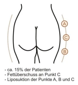 Runde Po-Form mit Behandlungspunkten A, B und C