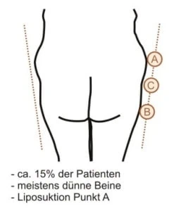 V-förmige Po-Form mit Behandlungspunkten A, B und C