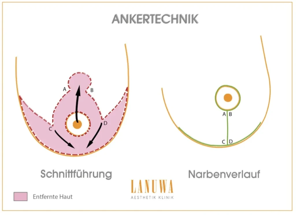T-Schnitt Technik bei der Brustverkleinerung - Ankerschnitt-Methode