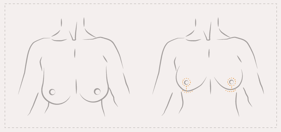 T-Schnitt Technik bei der Bruststraffung - umfangreichste Straffungsmethode